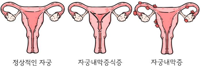 정상적인 자궁과 자궁내막질환인 자궁내막증식증, 자궁내막증의 모습을 비교한 이미지