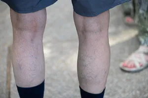 하지-정맥류-증상