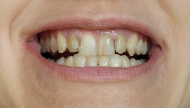 신경치료 후 앞니 변색&#44; 실활치 미백으로 해결&#44; 앞니 변색 치아