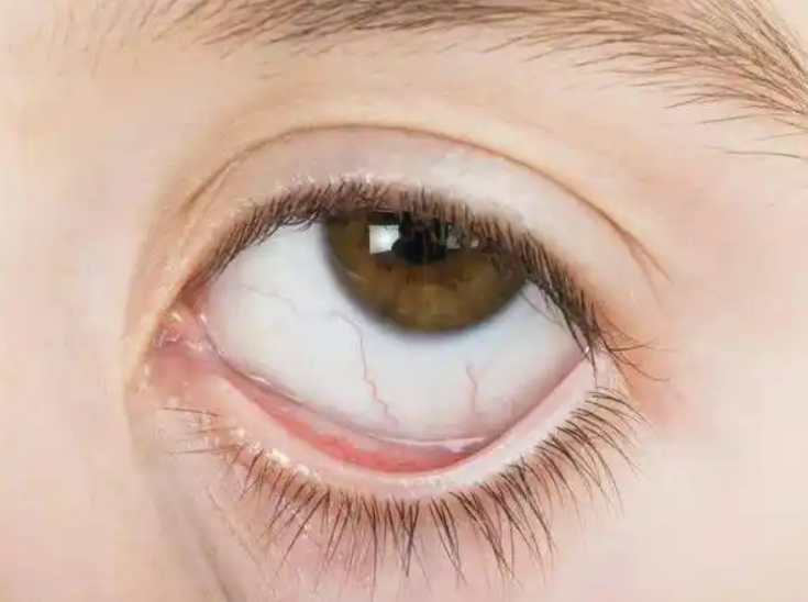 약국에서 눈 다래끼 빨리 낫는 법 : 형개연교탕 + 항생제 안약