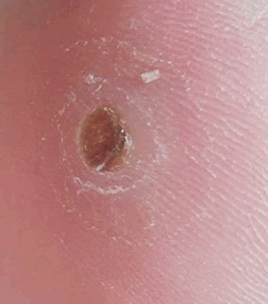 티눈 없애는 방법