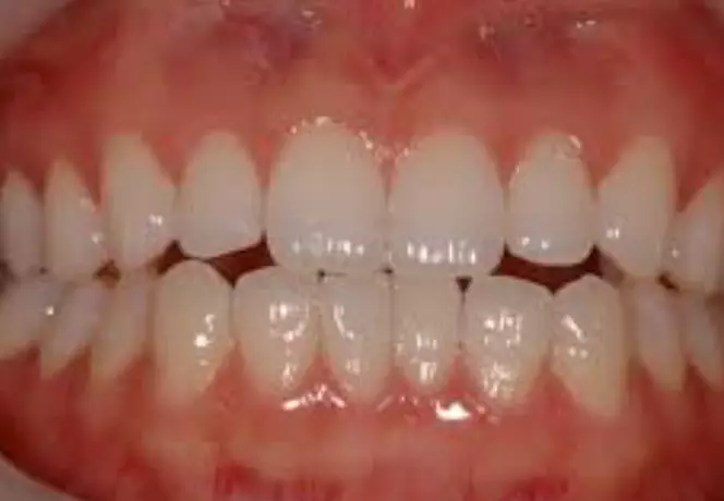 베타-시토스테롤-효능-부작용-건강