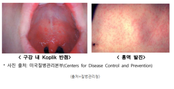 해외여행 전 홍역 예방접종 필수! 연령별 기준부터 접종 가격까지 총정리!(+베트남 홍역)