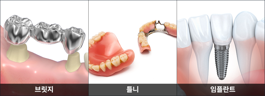 상실된 치아 방치 시 발생하는 치열 변형 및 임플란트 브릿지 틀니 구조 비교