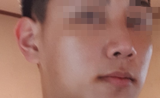 비중격 만곡증 수술 후기