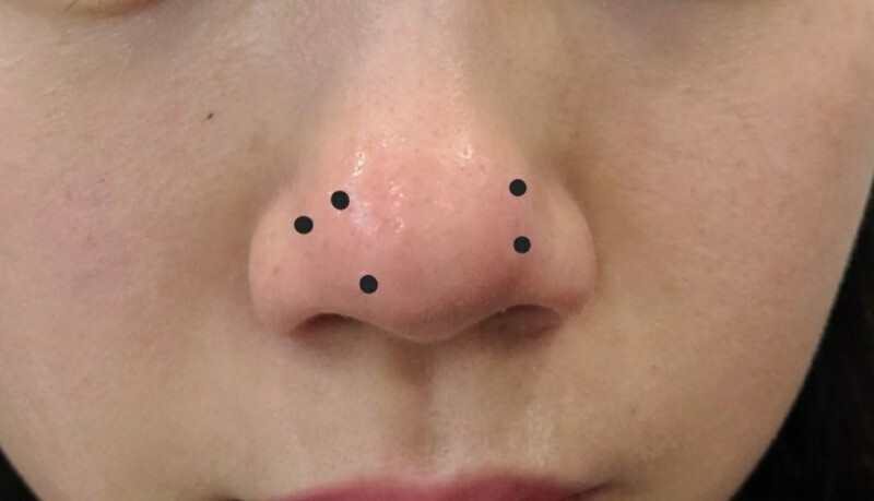 코조각주사 후기