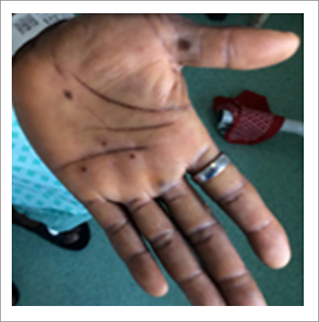 엠폭스 증상 원인 감염경로