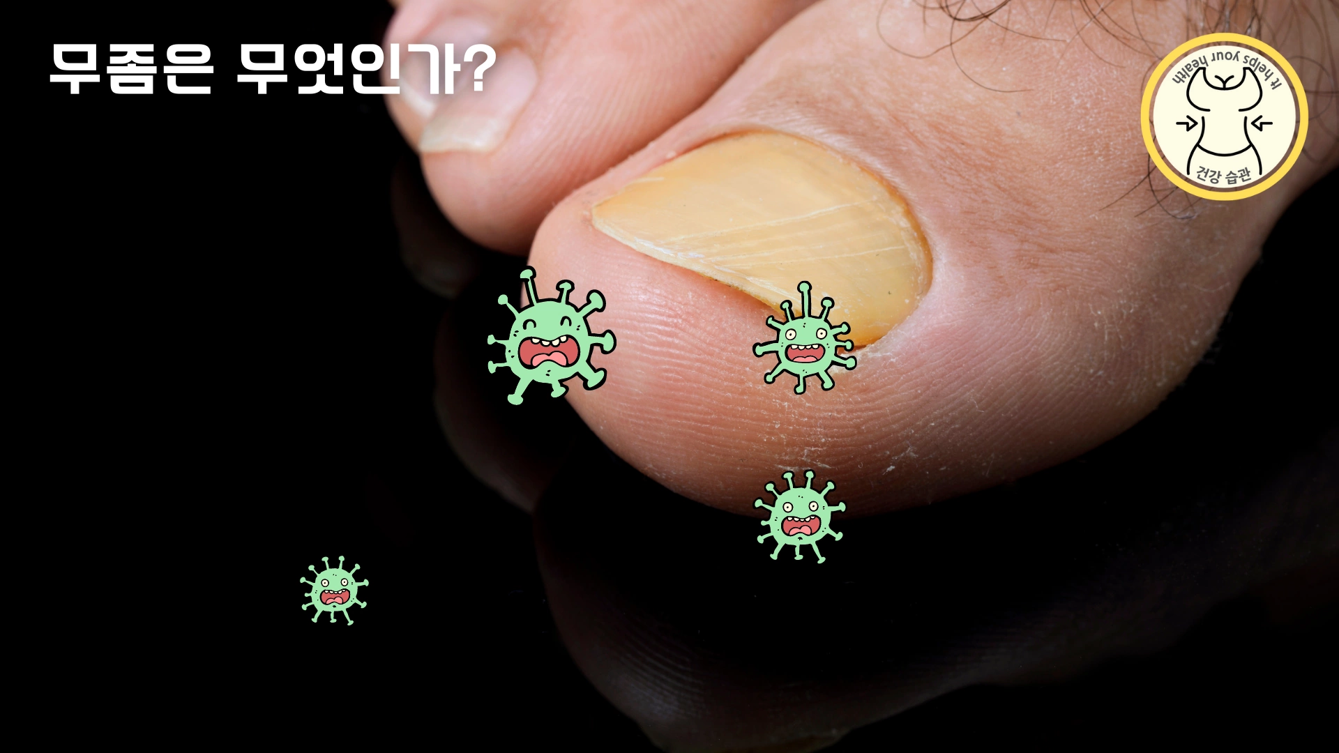 발톱 무좀의 증상 발톱 무좀의 증상