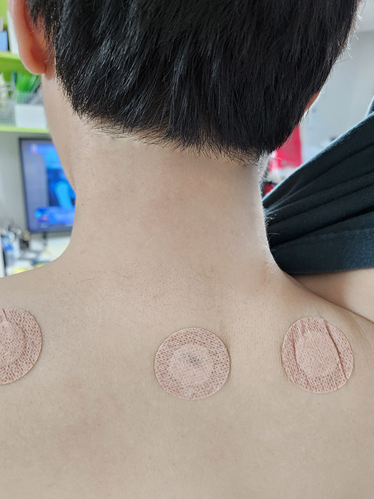 신경치료주사-목뒤편에맞은모습