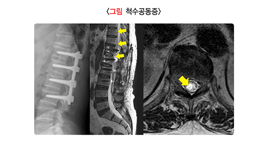 척추골절
