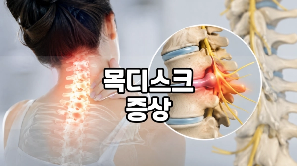 목디스크 증상