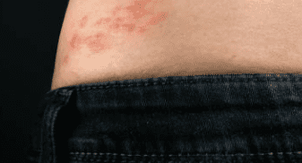 대상포진 예방접종 가격