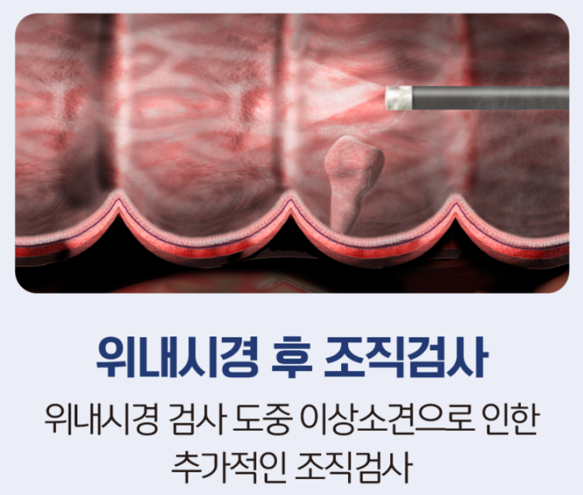  위내시경 조직검사 하는이유 