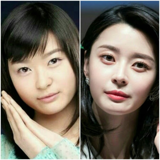 권나라 성형전