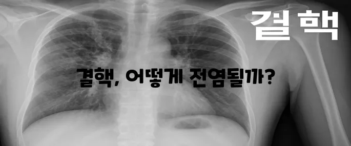 결핵의 전염성에 대해 알아보자