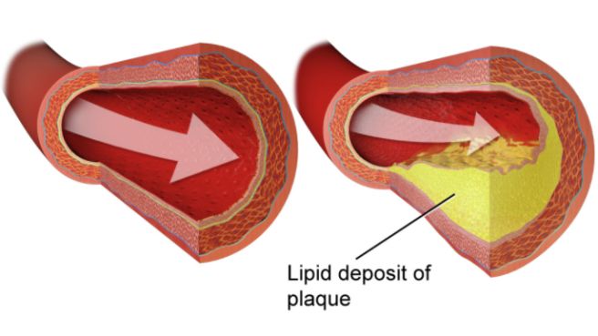 ldl 콜레스테롤 낮추는 방법