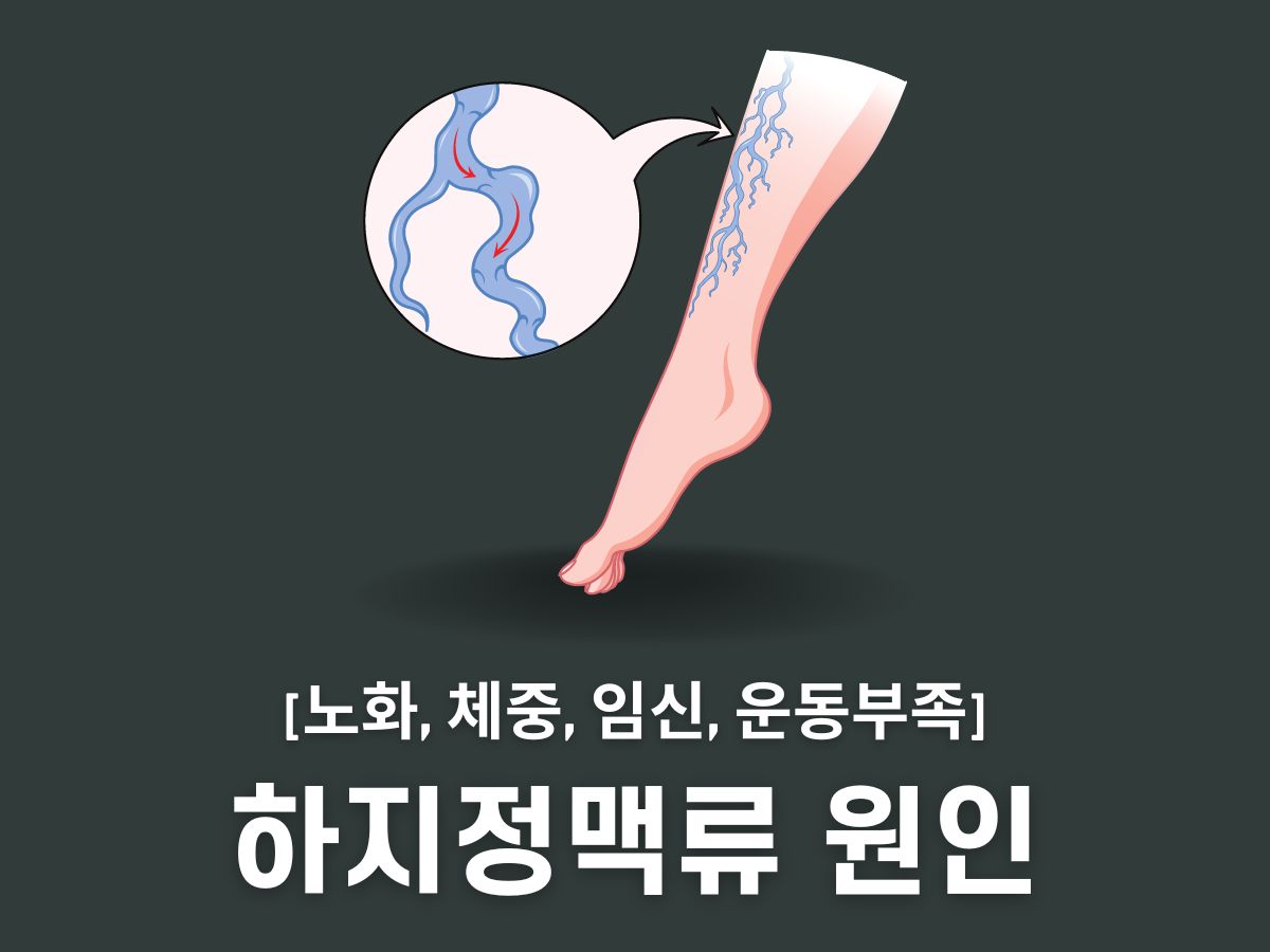 하지정맥류 원인