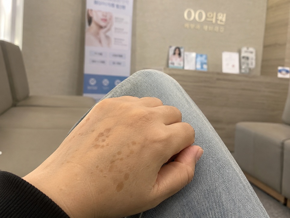 피부과 대기실에서 레이저 시술을 받기 전 손등에 선명하게 자리 잡은 검버섯 잡티 모습
