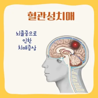 혈관성치매 원인 증상 치료법과 예방 생활습관_9