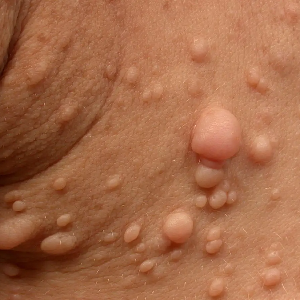 신경섬유종 초기 증상, 혹시 나도? 놓치면 안 되는 신호