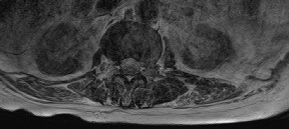 lumbar spine mri. axial image