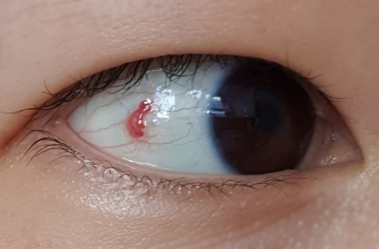 흰자 물집 제거 1일차 저녁