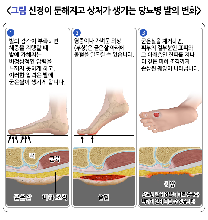 당뇨병 발의 변화