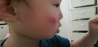 모기 물려 가려울 때 땀띠에 안티푸라민 연고 효능 부작용 사용후기_25