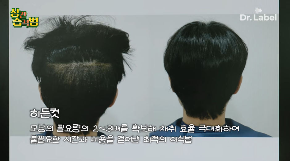 요새 생각보다 많은 여성들이 한다는 모발이식 시술 | 인스티즈