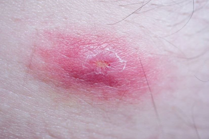 화농성 한선염 증상