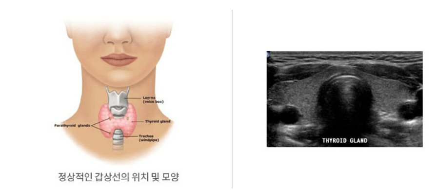갑상선 기능 저하증 증상, 원인, 검사, 좋은 음식