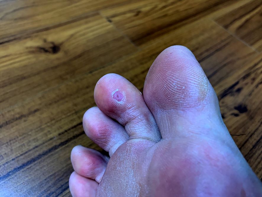 엔트와츠를 바른 뒤 효과를 보이고 있는 검지발가락