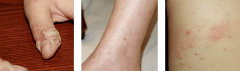 사마귀종류사진들