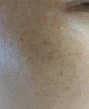 주근깨
