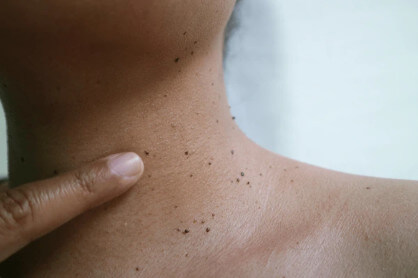 쥐젓 제거 크림의 효과와 사용법