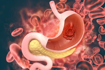 위암 2기 생존율