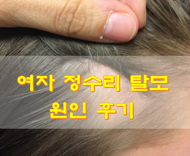 여자 정수리 탈모