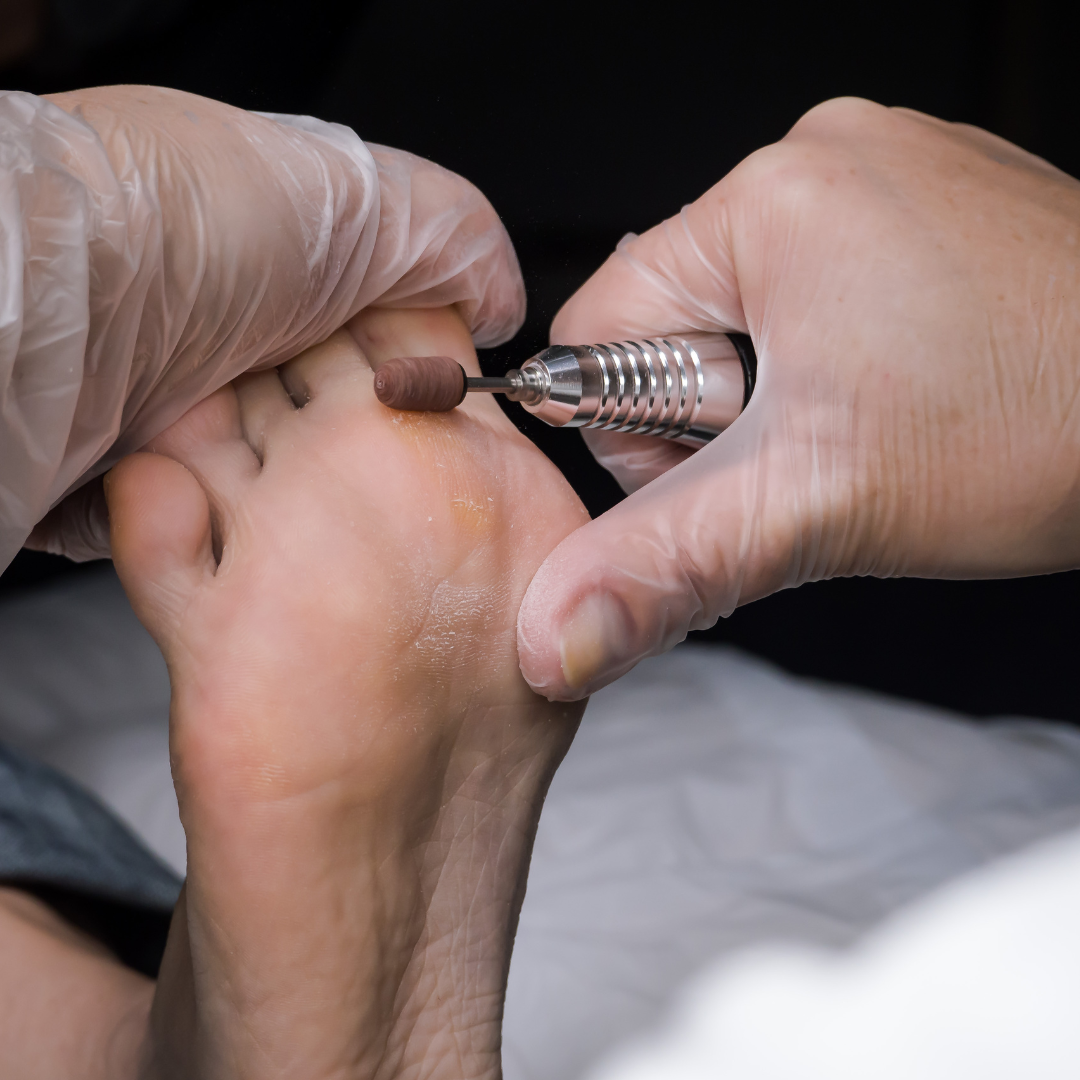 티눈과 굳은살 차이와 치료법, 발바닥 혹 없애는 법