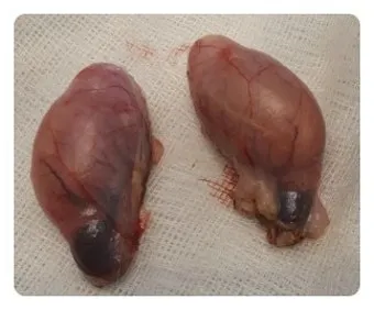 눈물샘 뚫는 수술 간단한가요에 대한 수술정보_18