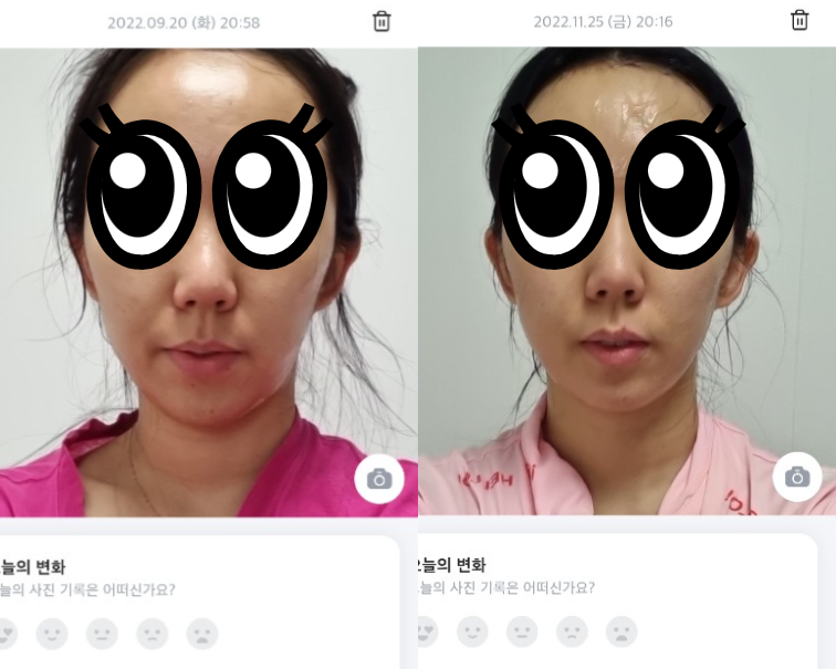 에이지알-내돈내산-전후사진