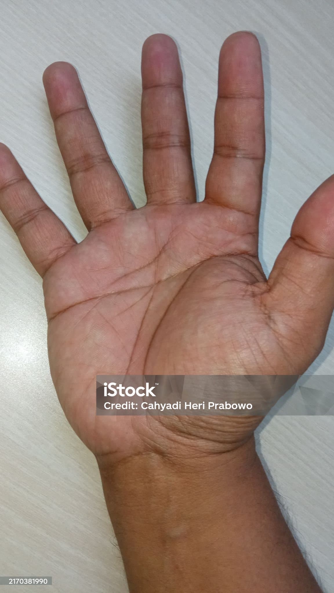 자고 일어나면 손이 부어요? 아침마다 붓는 이유