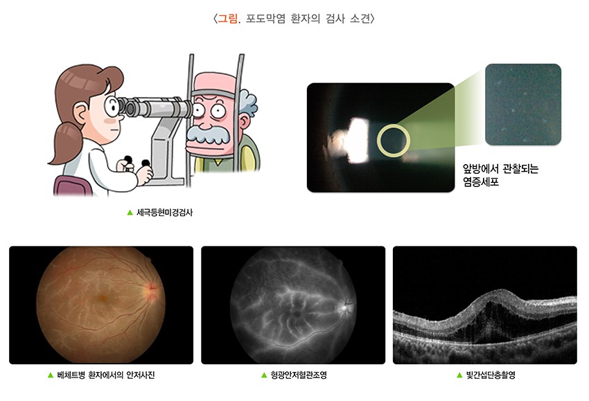 포도막염