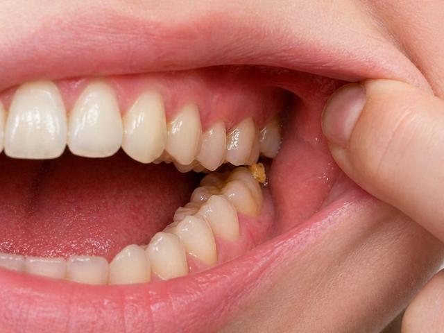 충치 증상 음식물 낌