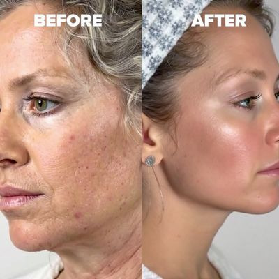 하이드로퀴논 기미 잡티 완화 효과1