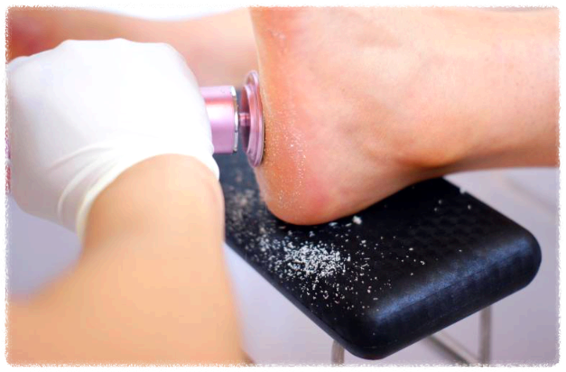 발 뒤꿈치에 각질에 발생하여 제거하는 모습의 이미지