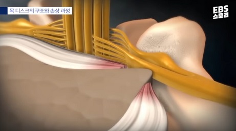 목디스크손상과정