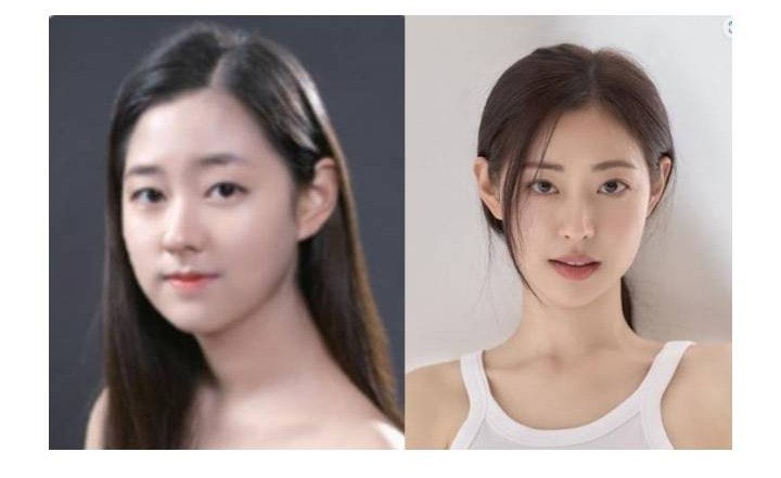 신슬기 성형 전