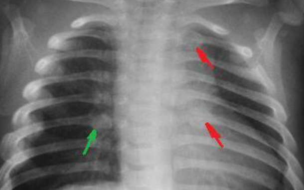 갈비뼈금간-사진4