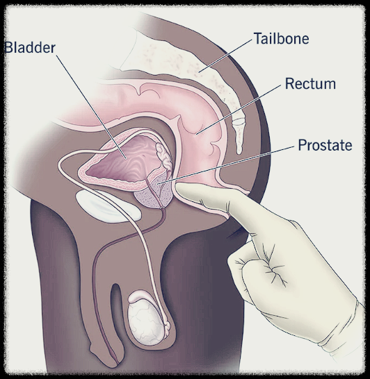 전립선비대증-검사방법