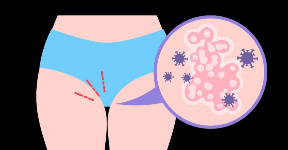 사타구니 가려움증